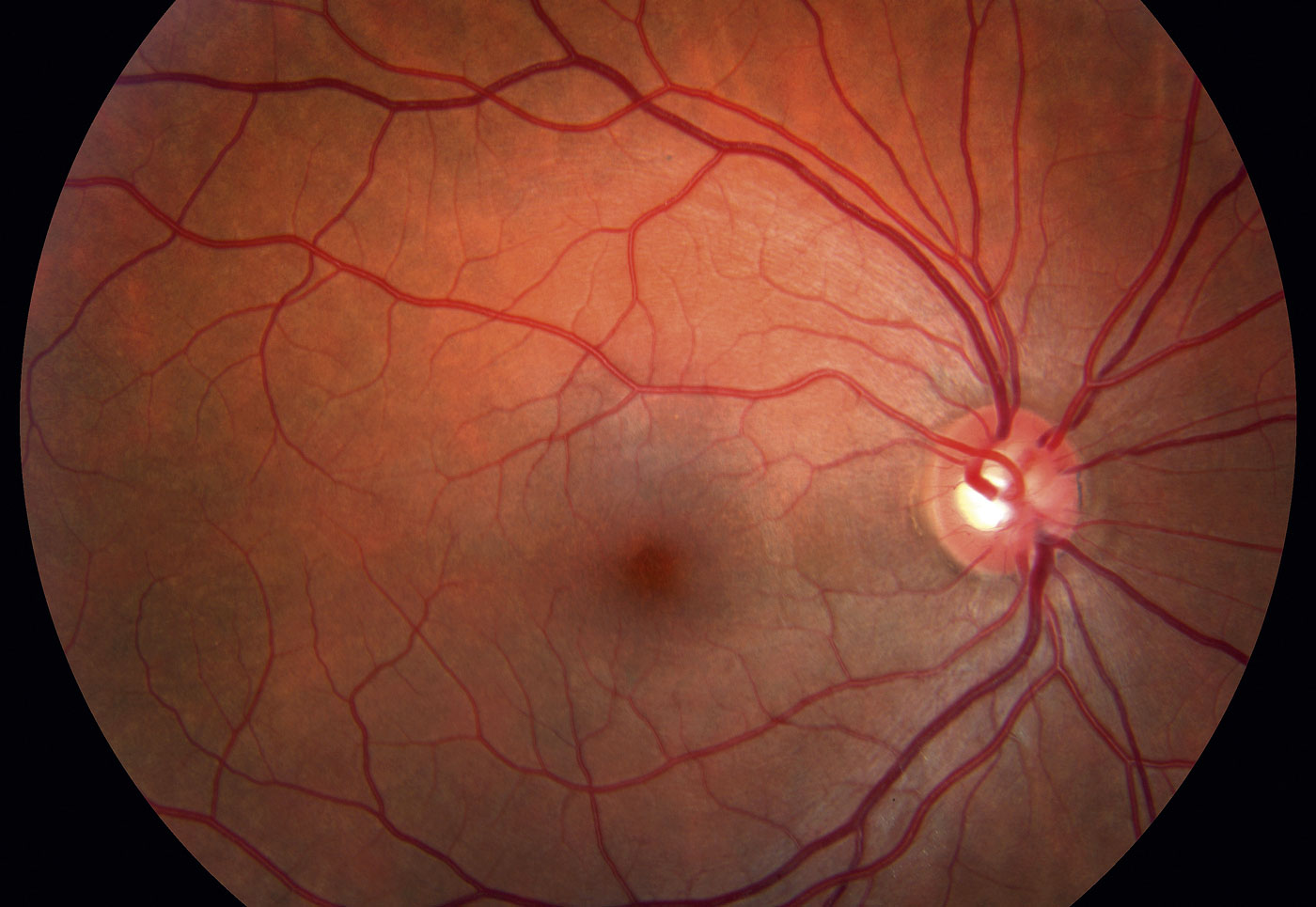 Отек зрительного нерва