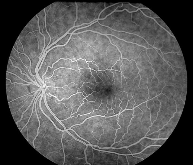 ангиография