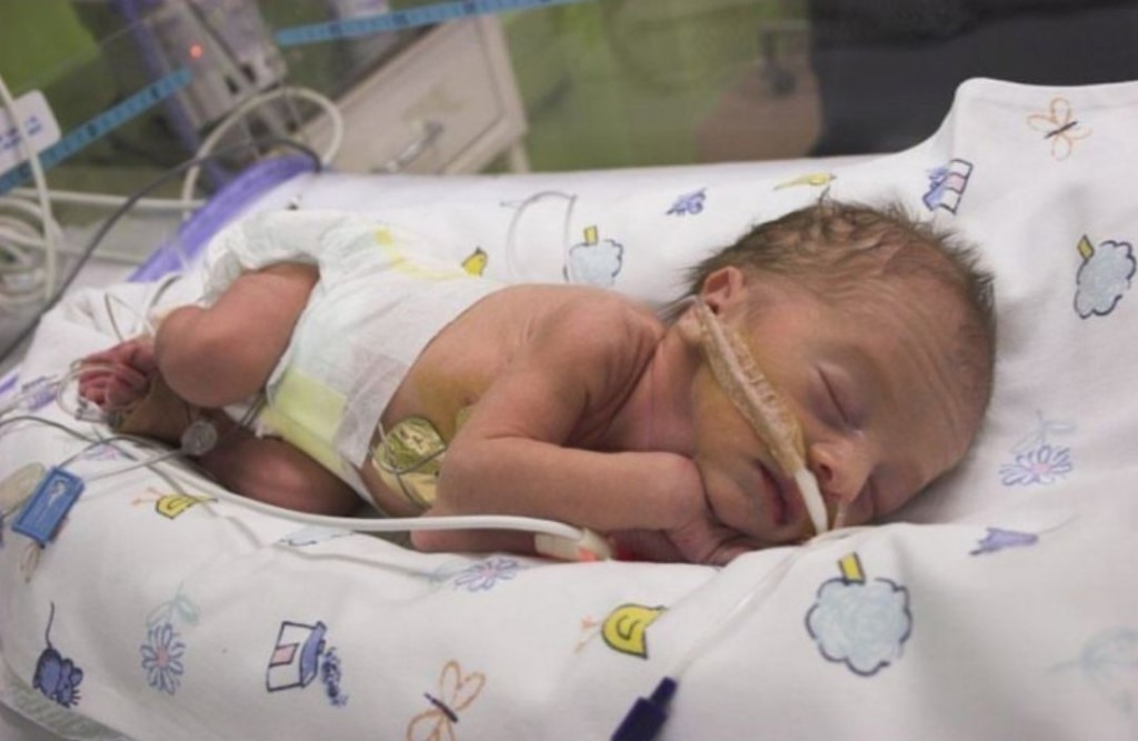 Ретинопатия недоношенных