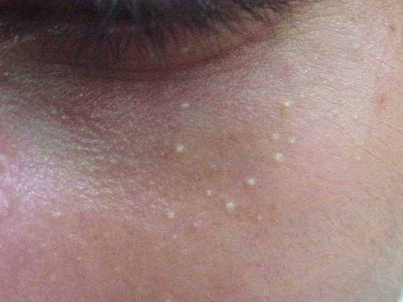 Милиумы на лице