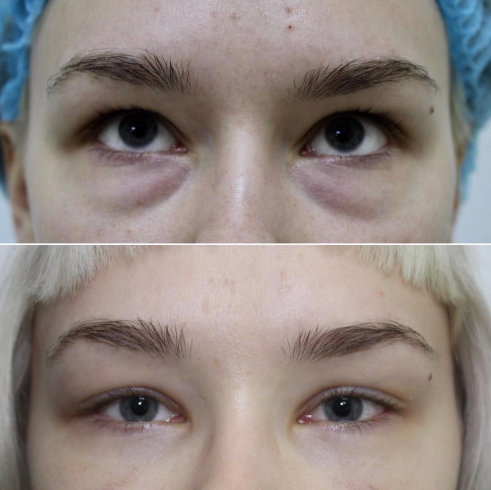 Подготовка к трансконъюктивальной блефаропластике