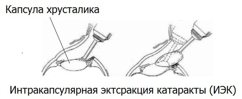 Интракапсулярная экстракция