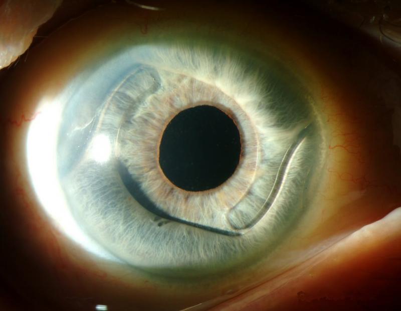 Лучшие хрусталики для глаз при катаракте