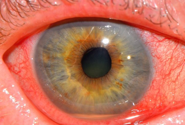 Иридоциклит