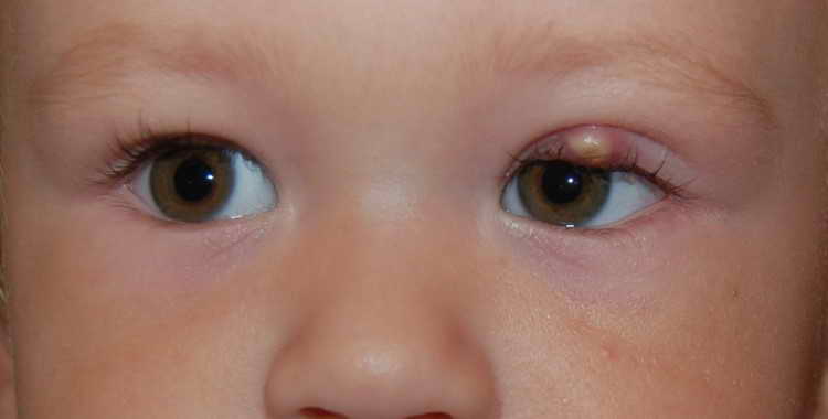 Чирей на глазу у ребенка