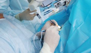 операция катаракты при глаукоме