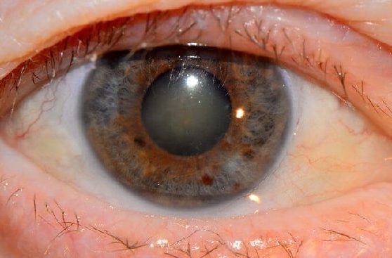 Повторная катаракта после замены хрусталика