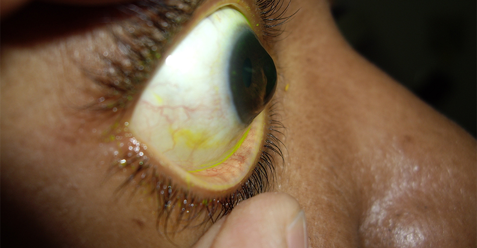 Список заболеваний глаз у человека - описание симптомов