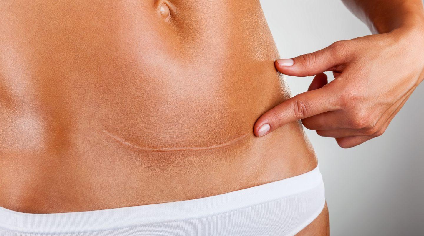 Роды и миопия