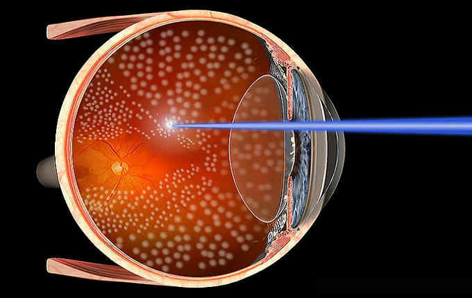 Лазерная коагуляция сетчатки глаза при беременности