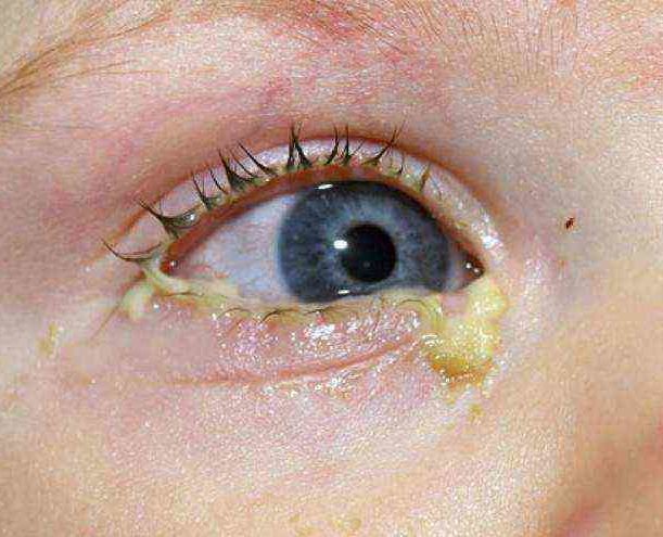 Гнойный конъюнктивит у ребенка - как и чем лечить