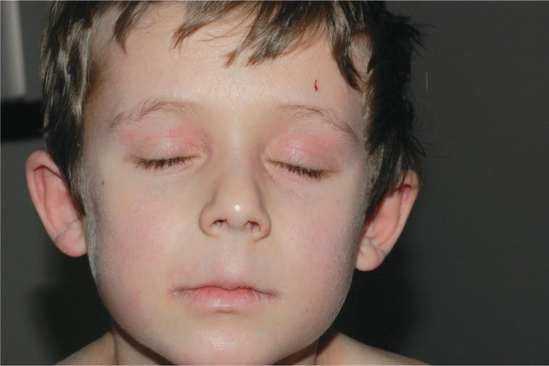 Терапия дерматита глаз у детей