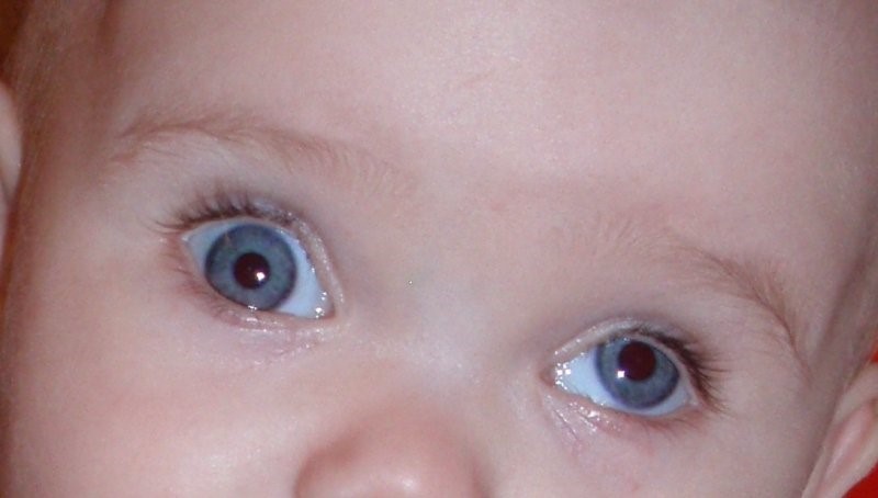 Экзотропия