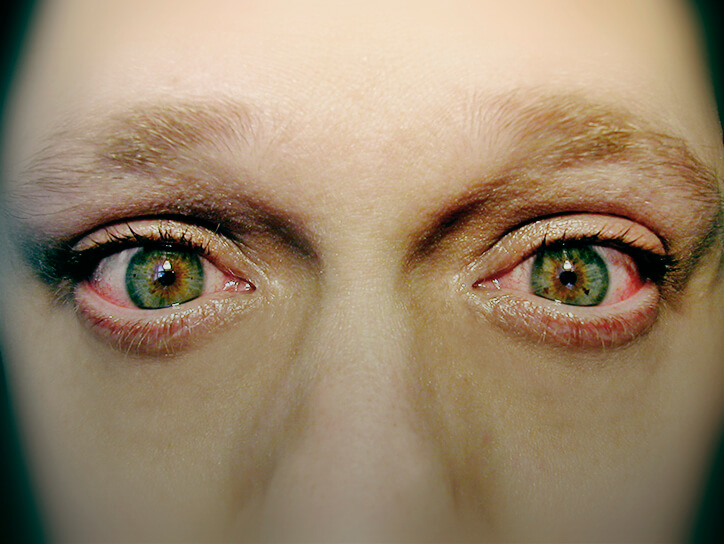 Блефароконъюнктивит