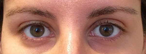 Впалые глаза