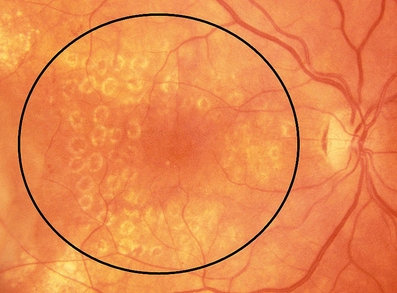 Макулопатия сетчатки