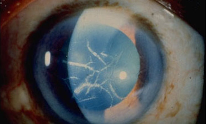 Эндотелиально-эпителиальная дистрофия роговицы (ЭЭД)