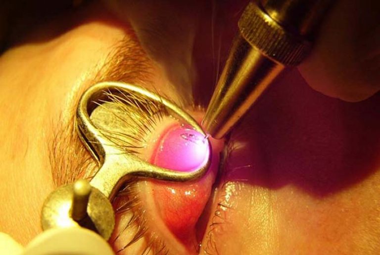 Особенности удаления халязиона у детей