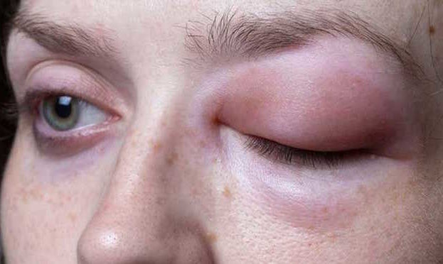 Инфекции глаз