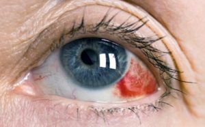 Кровоизлияние в стекловидное тело глаза