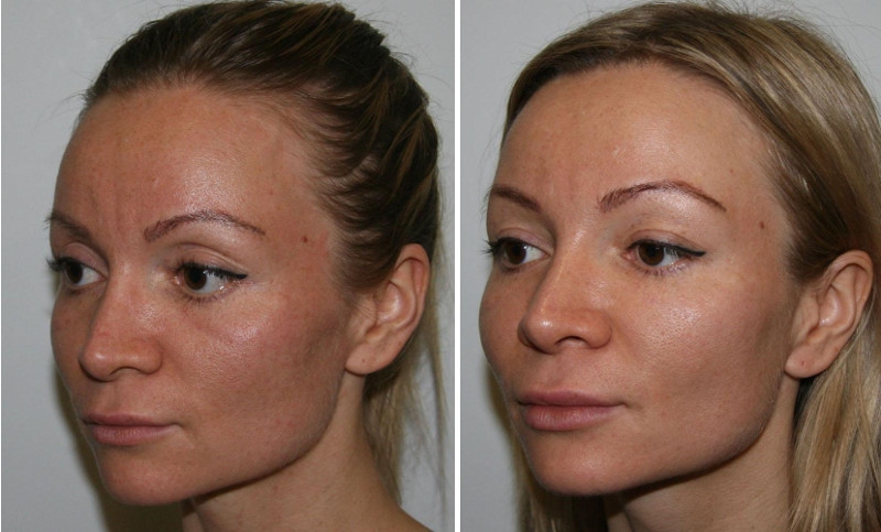 Как убрать малярные мешки под глазами