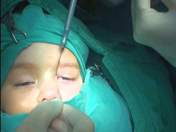 Зондирование слезного канала у детей