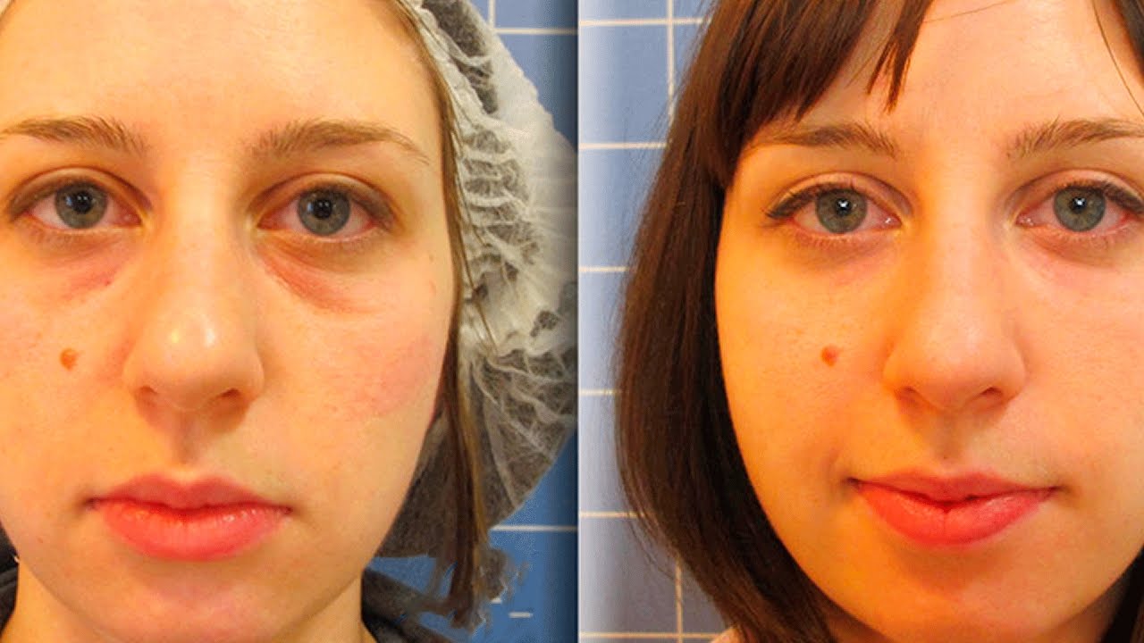 Как убрать слезную борозду под глазами