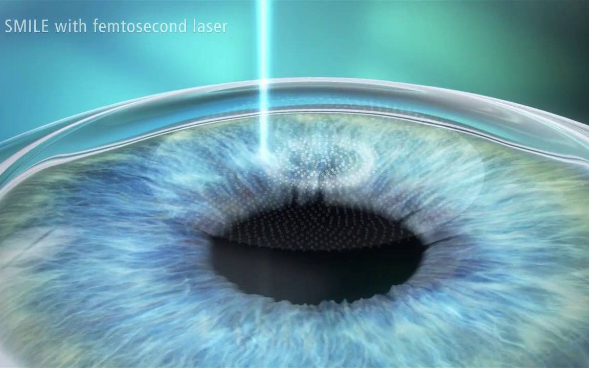 Лазерная коррекция зрения Смайл (Relex Smile)