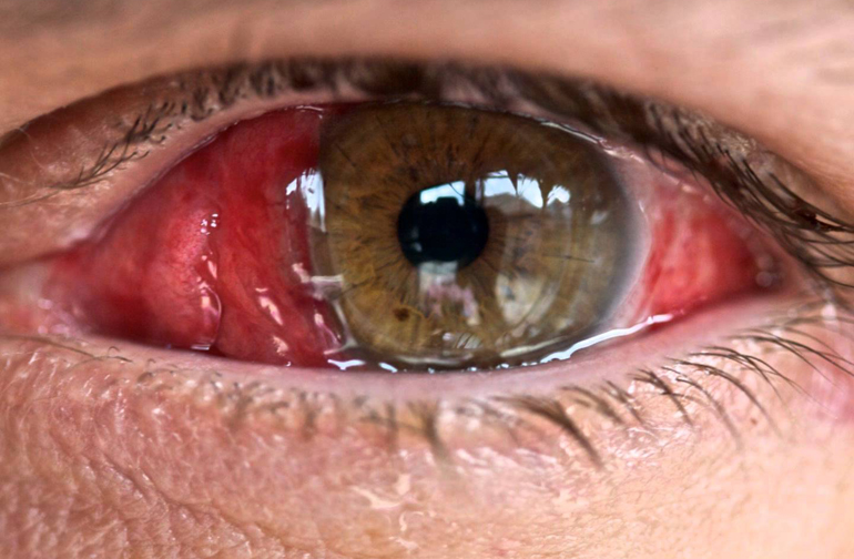 Химический ожог глаза