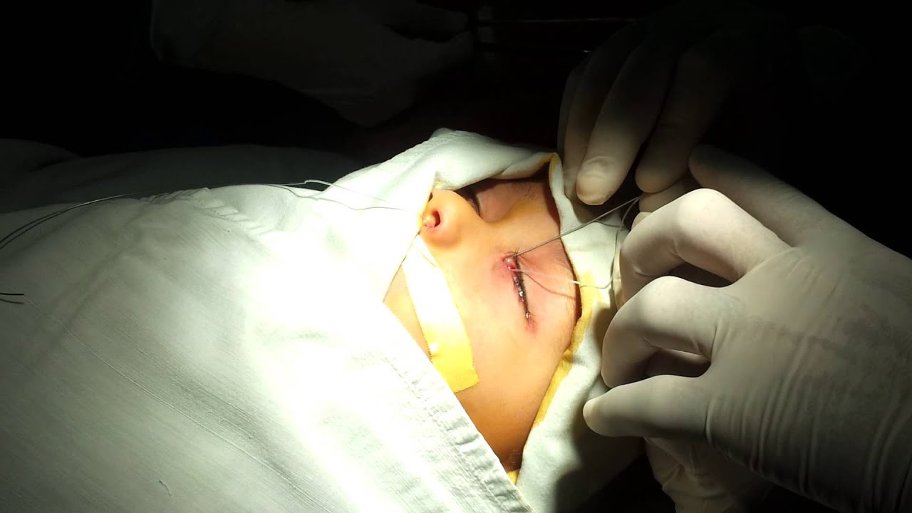 Дакриоцистит - воспаление слезного канала