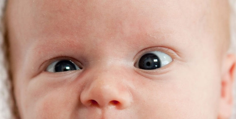 Когда стоит лечить косоглазие у малыша