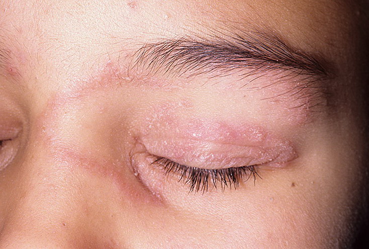 Грибок глаз