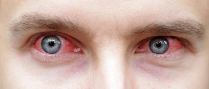 Эписклерит глаза