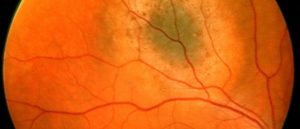 Невус хориоидеи на глазу