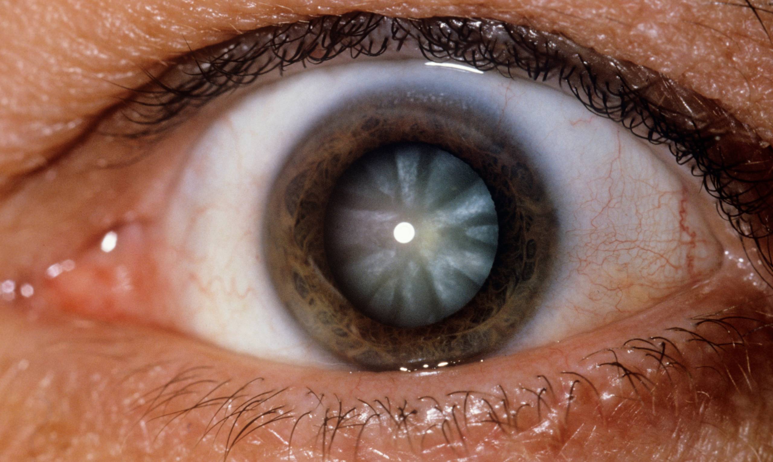 Слепота - полное отсутствие зрения