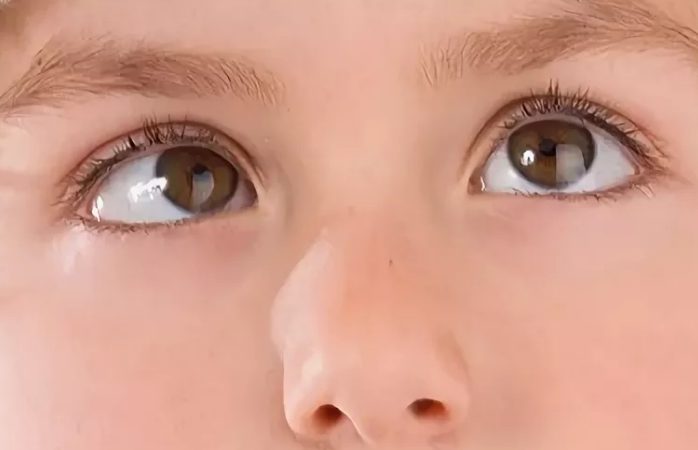 Горизонтальный нистагм