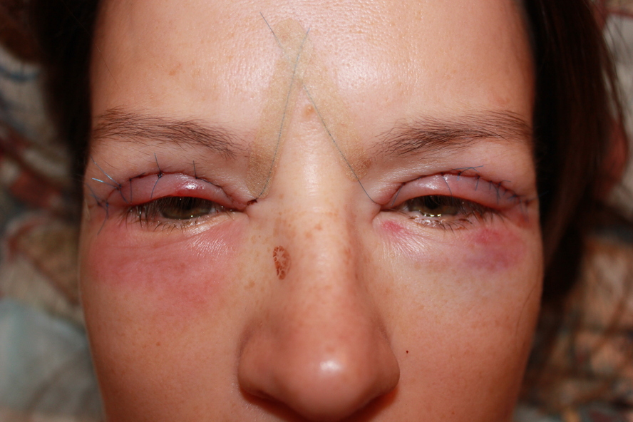 Как снять отеки после блефаропластики