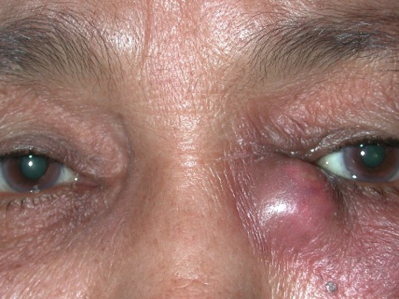 Воспаление слезного мешочка