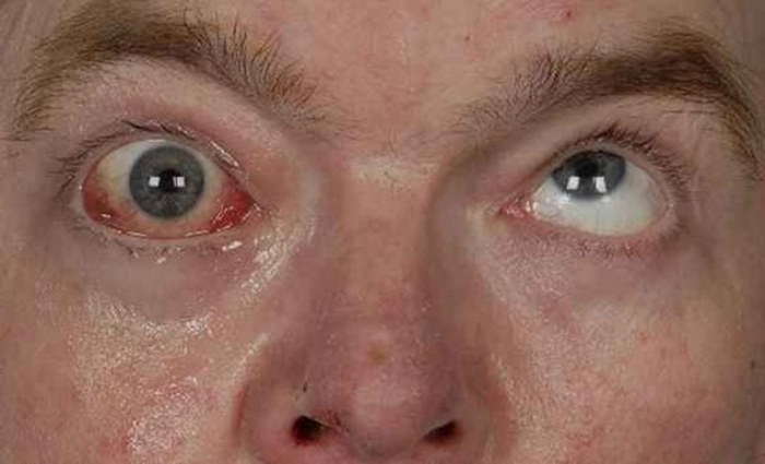 Боязнь света - признак какого заболевания