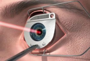 Невус хориоидеи на глазу