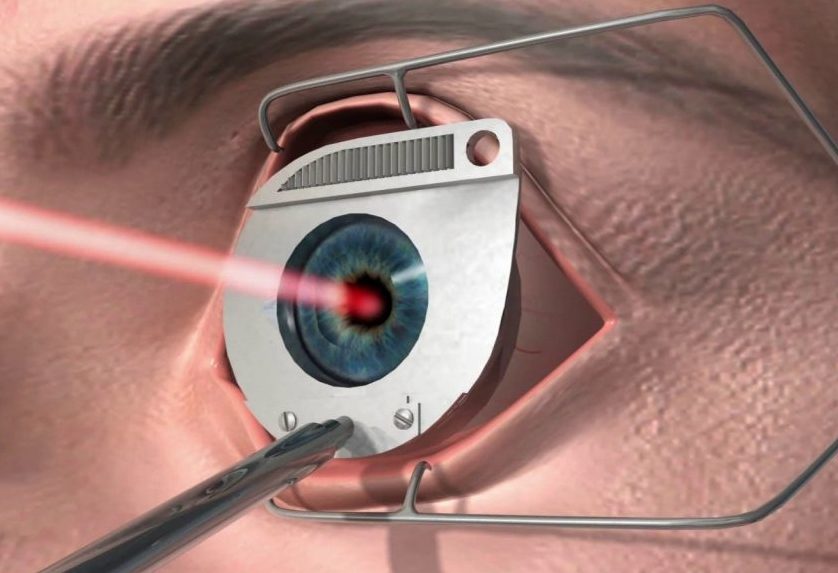 Что такое гиперметропия высокой степени (3 степень)