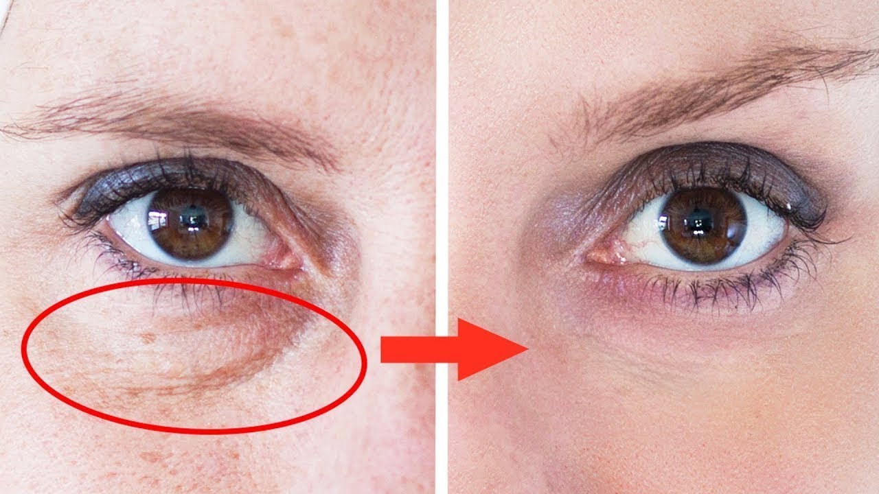 Эффективность мезотерапии