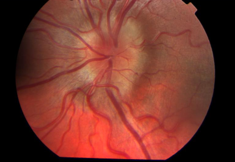 Застой диска зрительного нерва