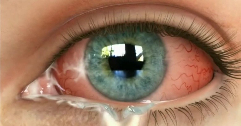 Почему закисают глаза у взрослого