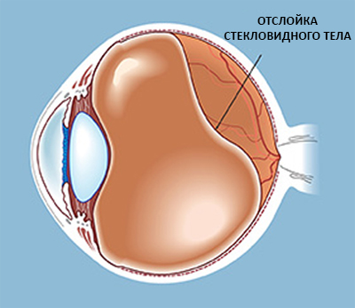 Отслойка стекловидного тела