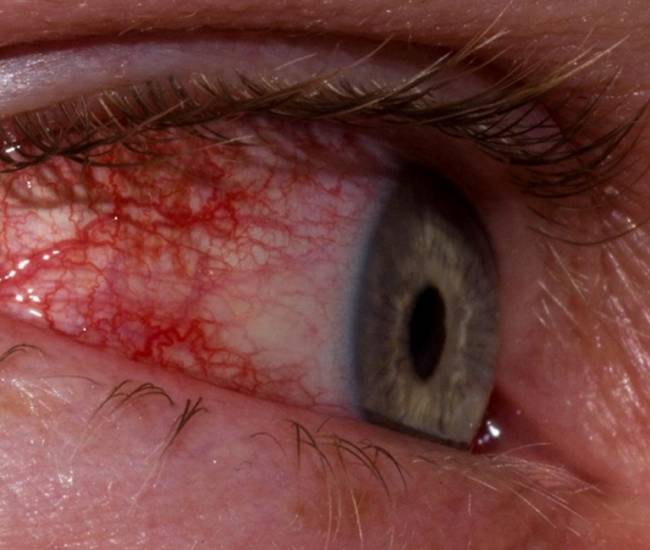 Симпатическая офтальмия