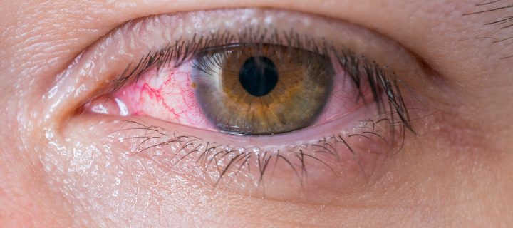 Ожог роговицы глаза