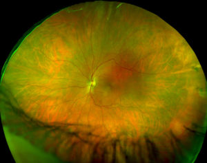 Хориоретинальная дистрофия сетчатки