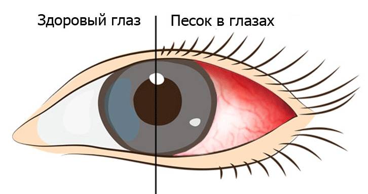 Ощущение песка в глазах