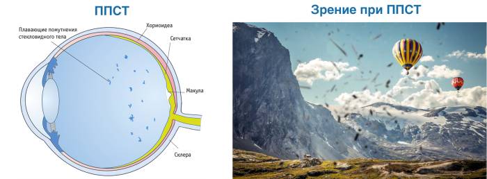Плавающие помутнения в стекловидном теле